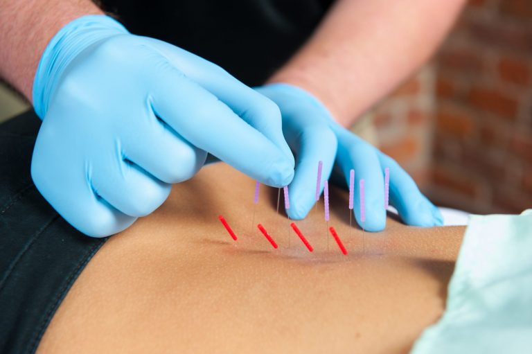 Dry Needling Physical Therapy Clinic Of Lafayette 1567